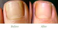 Definition of Nail Fungus