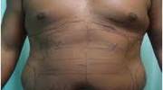 Abdominal Liposuction