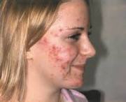 Know about Acne