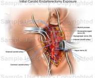 About Carotid Surgery