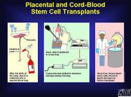 Cord Blood Stem Cell