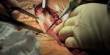 Hysterectomy Surgery