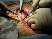 Hysterectomy Surgery