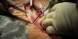 About Hysterectomy Surgery
