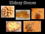 Cause of Kidney Stones