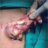 Laparoscopic Kidney Surgery