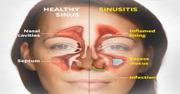 Know about Sinus Infection