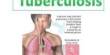 Know about Tuberculosis