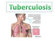 Know about Tuberculosis