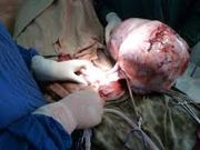 Tumor Surgery