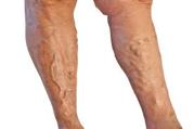 Know About Varicose Veins