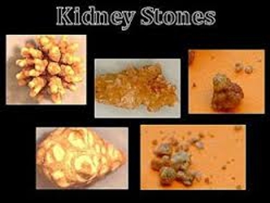 Kinds of Kidney Stones