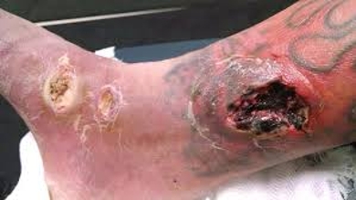 abscesses foot gore ankle assignment drained ran calf both above were mine friend had point assignmentpoint