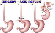 Acid Reflux Surgery