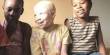 Know about Albinism