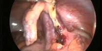 Know about Appendix