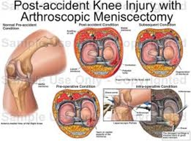 Arthroscopic Meniscectomy