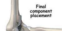 Elbow Joint Replacement