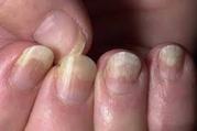 About Fingernail Fungus