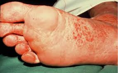 Foot Fungal Infections