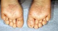 Foot Hyperhidrosis