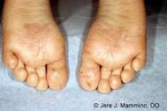 Foot Hyperhidrosis