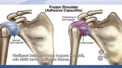 About Frozen Shoulder