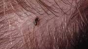 Get Rid of Head Lice