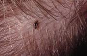 Get Rid of Head Lice