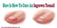 Ingrown Nails