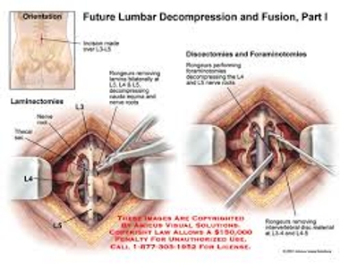 Lumbar Decompression