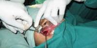 Maxillary Sinus Surgery