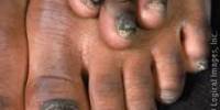 About Onychomycosis