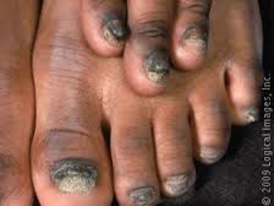 About Onychomycosis