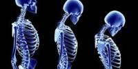 Discuss about Osteoporosis