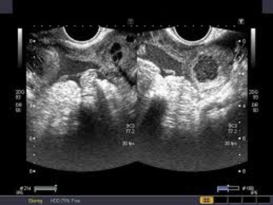 Ovarian Cysts During Pregnancy