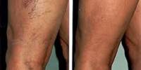 About Sclerotherapy