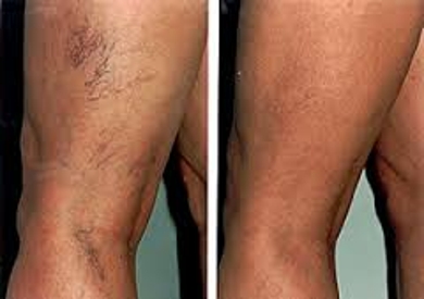 About Sclerotherapy