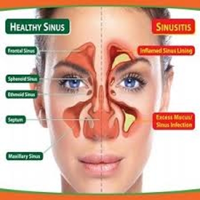 Know about Sinusitis