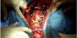 Know about Spine Surgery