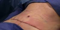 Know about Tummy Tuck Surgery
