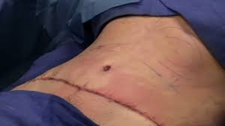 Know about Tummy Tuck Surgery