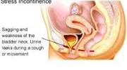Urinary Stress Incontinence