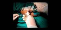 Haemorrhoid Surgery