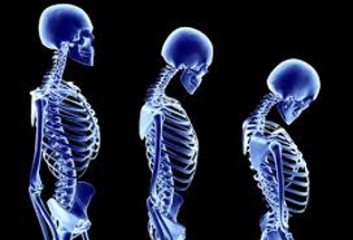 Analysis about Osteoporosis