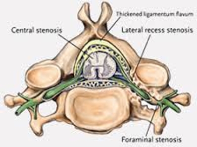 About Spinal Stenosis