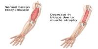 Muscle Atrophy Treatment