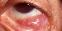 Ocular Lymphoma