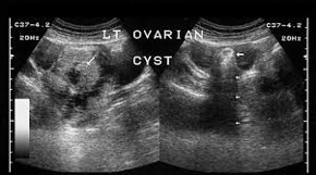 Abnormal Ovarian Cysts