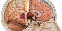 Astrocytoma Brain Cancer Tumors